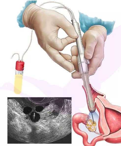 江苏代孕的出生证是真的吗|做试管需要经历以下两个小手术，即取卵手术和胚